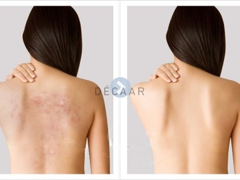 Mụn đầu trắng ở lưng